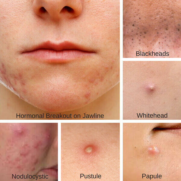 pustule acne treatment